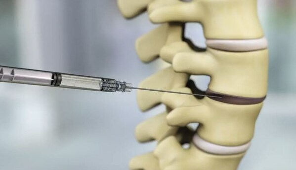 DiscGenics Announces Positive Two-Year Clinical Data from U.S