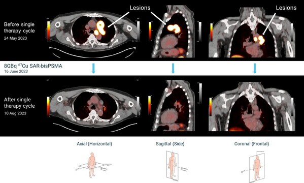 First participant treated at the highest dose level in Clarity's theranostic prostate cancer trial