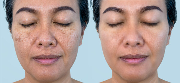 The Australian Photoageing Re